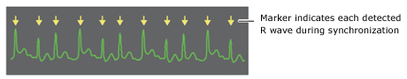 Defibrillator Cardioversion R Wave