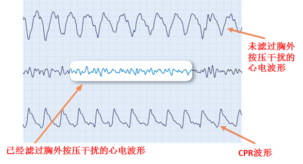 See-thru CPR Waveform - Chinese