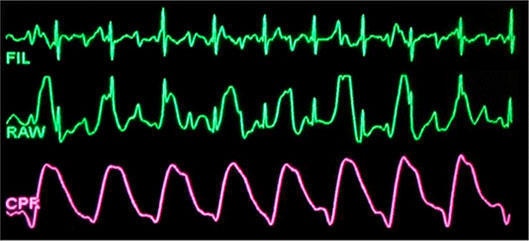 See-thru Cardiopulmonary Resuscitation (CPR) waveform