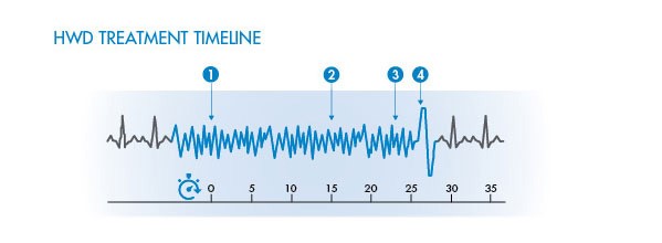 How the HWD Works - Treatment Timeline